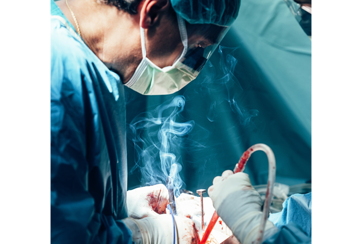 The Top 3 Dangers of Surgical Smoke